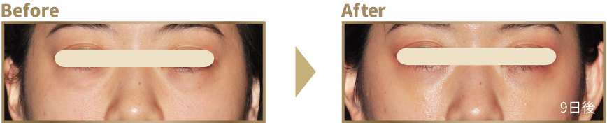 下まぶたのたるみ取り ビフォーアフター
