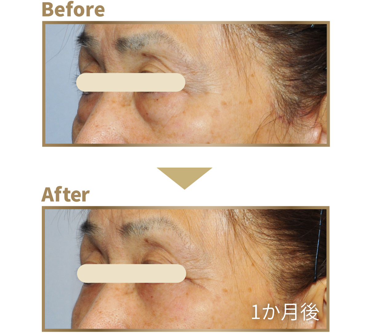 下まぶたのたるみ取り ビフォーアフター