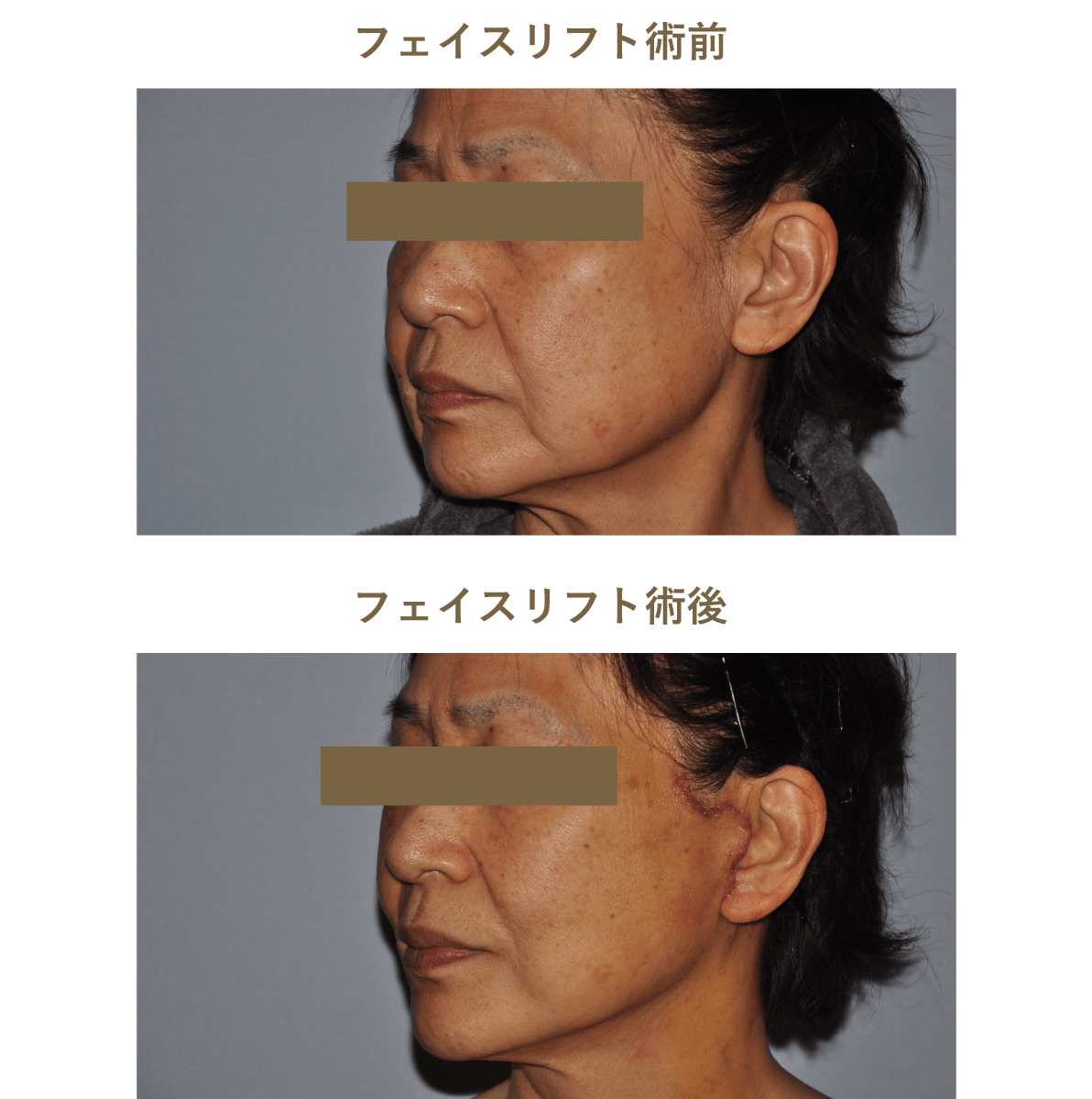 フェイスリフト術前術後のイメージ