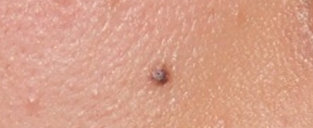 単純黒子(ほくろ)