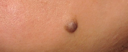 毛が生えたほくろ