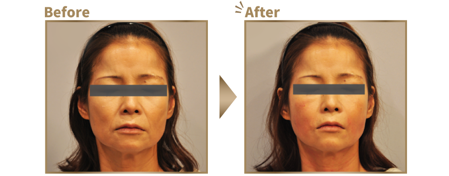ヒアルロン酸を顔全体に注入したビフォーアフターイメージ