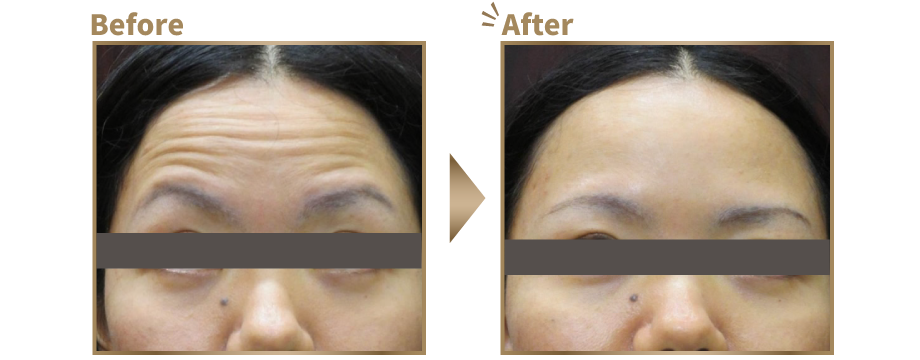 おでこのしわ寄せ ビフォーアフター