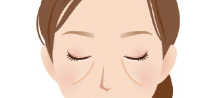 目の下のくま・たるみ（ミッドチークライン・ゴルゴライン）