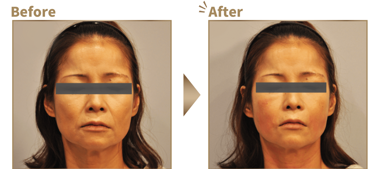 ヒアルロン酸を顔全体に注入したビフォーアフターイメージ