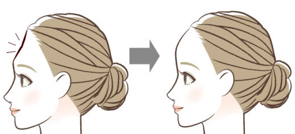 おでこを丸くしたい