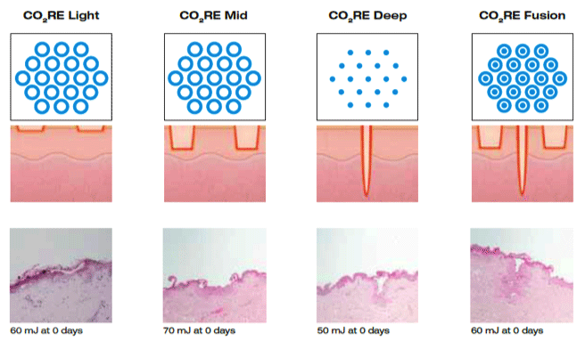 フラクショナルCO2レーザーとは