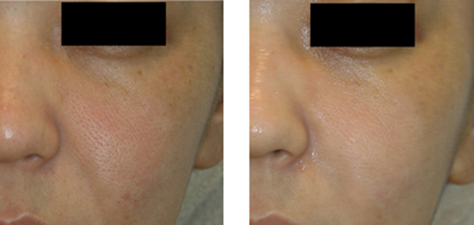 しわ・たるみに効果的な治療