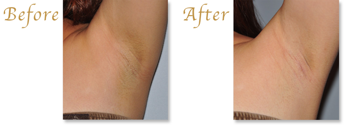 わきが治療・ワキガ手術