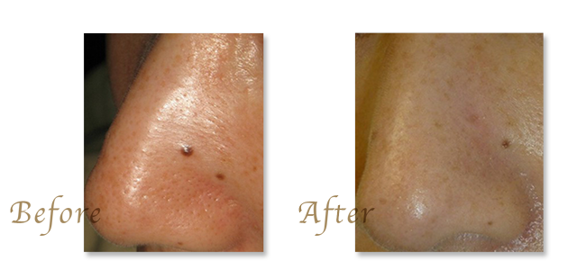 ほくろ・黒子・ホクロ除去