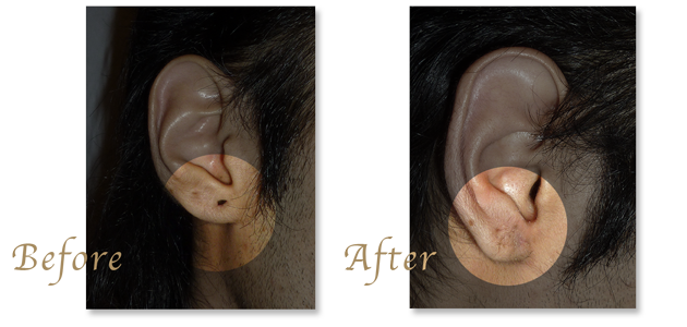 ピアッシング・ピアス穴閉鎖