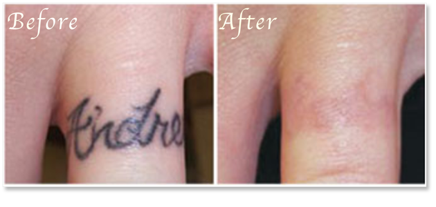 タトゥー刺青レーザー除去