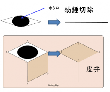 ほくろ・黒子・ホクロ除去