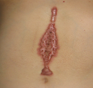 瘢痕修正・ケロイド治療