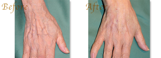 ヒアルロン酸注で手背の若返り