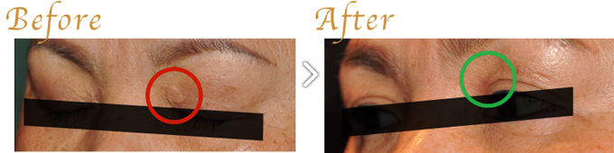 目の上の黄色腫（平たい黄色いイボ）