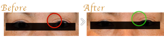 目の上の黄色腫（平たい黄色いイボ）