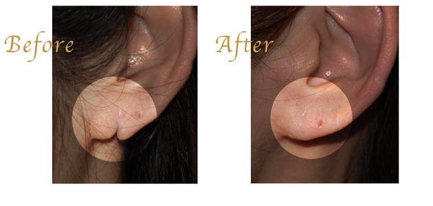 ピアスで裂けた耳垂裂