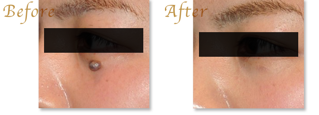 ほくろ・黒子・ホクロ除去