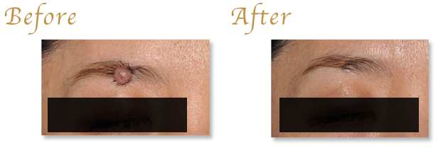 ほくろ・黒子・ホクロ除去