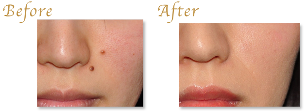 ほくろ・黒子・ホクロ除去