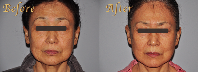 フェイスリフト