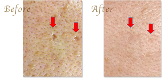 にきび跡の治療