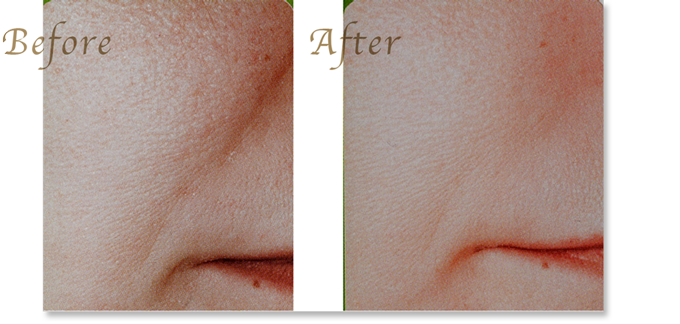 ヒアルロン酸・ボトックスでしわを消す