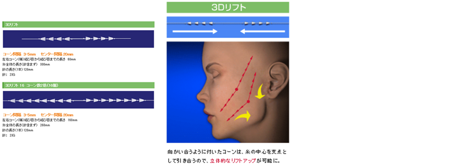 リフトアップ手術