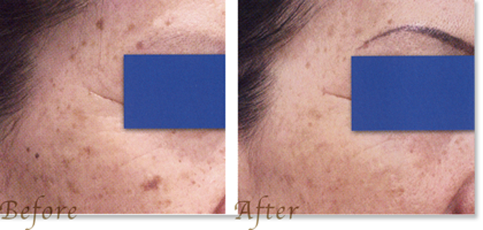 しみ・そばかす・くすみ・赤み