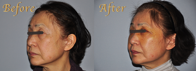 老化・目の下のたるみ