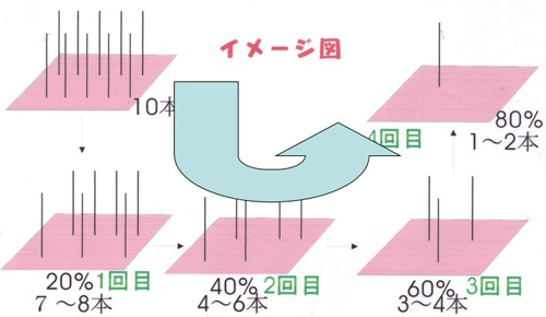 脱毛・毛周期に合わせて数回の施術