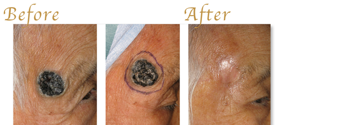 悪性など皮膚腫瘍の切除および再建