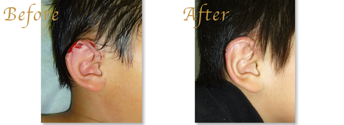 耳介形成/変形や外傷