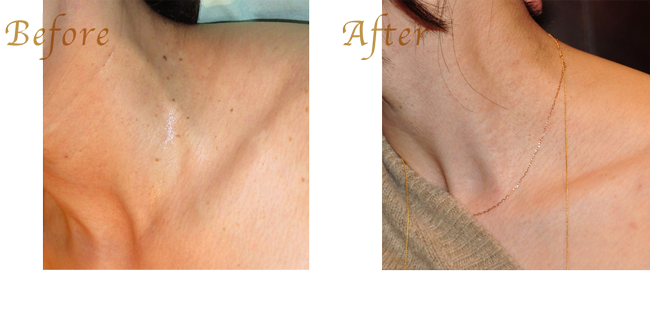 イボ（アクロコルドン）