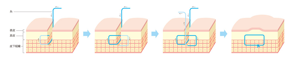 真皮縫合イメージ