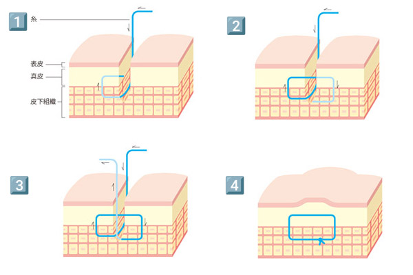 真皮縫合イメージ