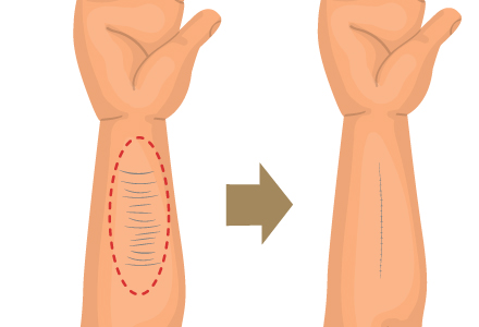 切除法イラスト