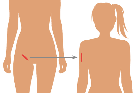 皮膚移植法(植皮術)